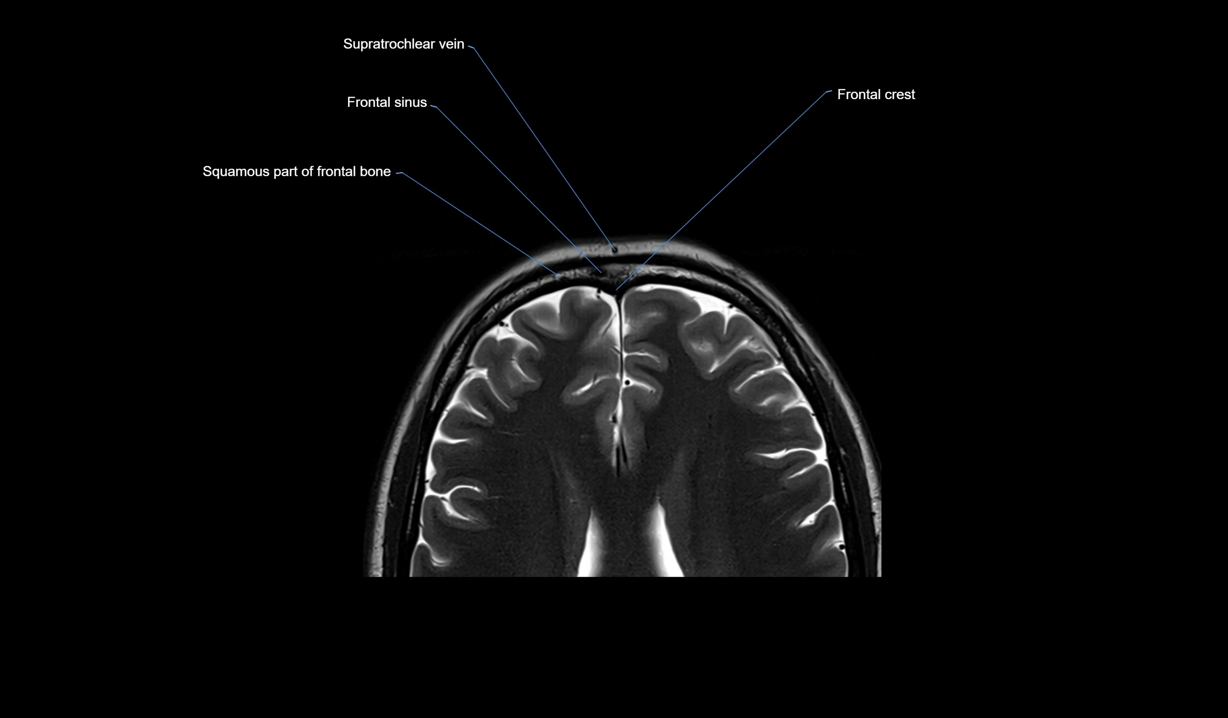 MRI face & paranasal sinuses(PNS) labelled  coronal  cross sectional anatomy 3T radiology  image-img-00001-00035.webp